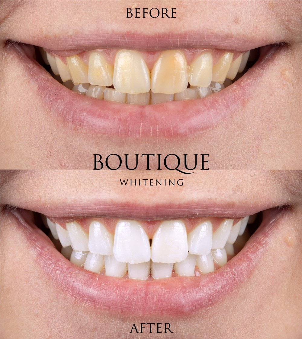whitening-BEFORE-AFTER-1000