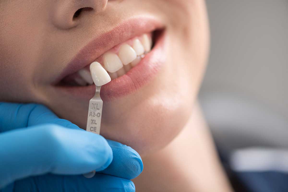 Dental-Crowns