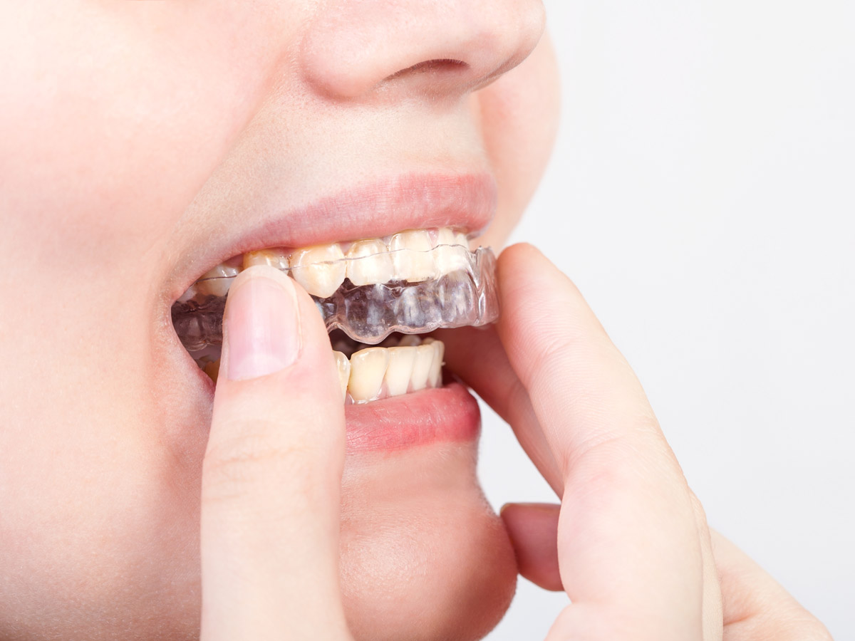 mouth-guards-1